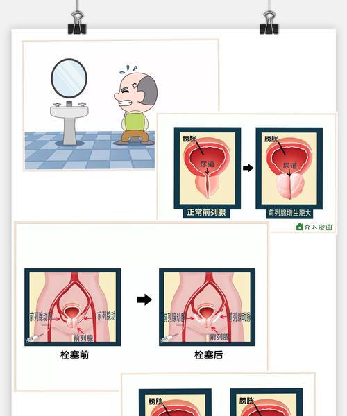 当归芍药散能治疗前列腺增生吗？使用方法是什么？